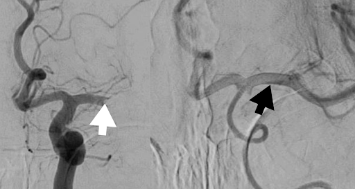 Large block in a middle cerebral artery