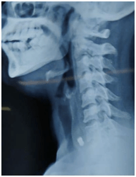 x-ray of the neck