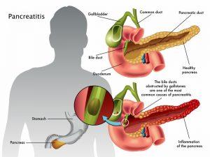 What is the Pancreas and the disorders associated with it?