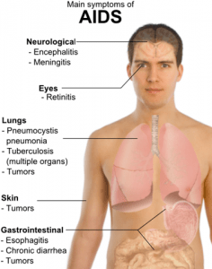 symptoms of HIV