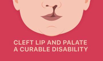 CLEFT LIP AND PALATE