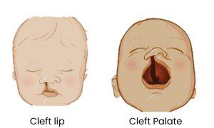 Cleft lip & Cleft Palate