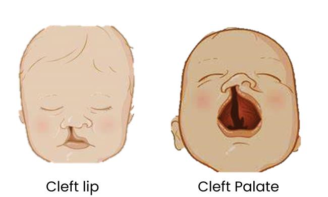 Cleft Lip And Palate: A Curable Disability 