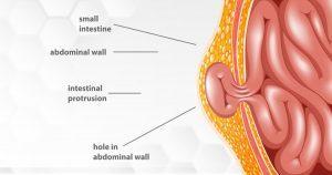 How to identify Hernia 