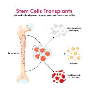 Stem Cells Transplant