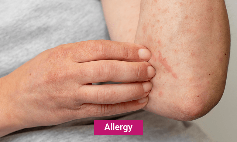 Allergy - Blog by Ramaiah Memorial Hospital